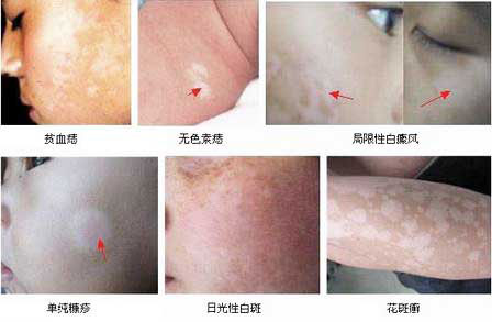 白斑与白癜风的区别
