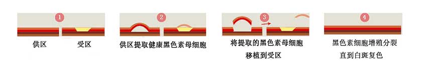 黑色素种植示意图 黑色素种植示意图