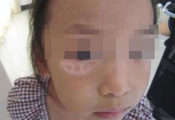 6岁小孩脸上长白斑