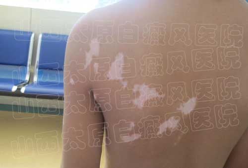 身上长白斑怎么治疗