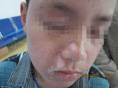 青少年得了白癜风多久能治好?