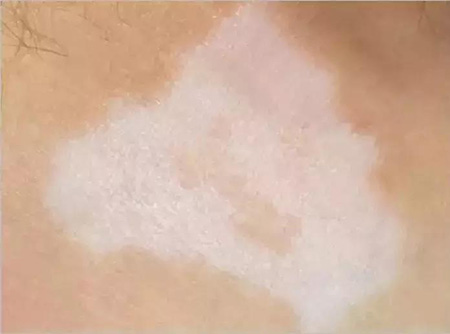 身上白癜风不扩散了还需要治疗吗?