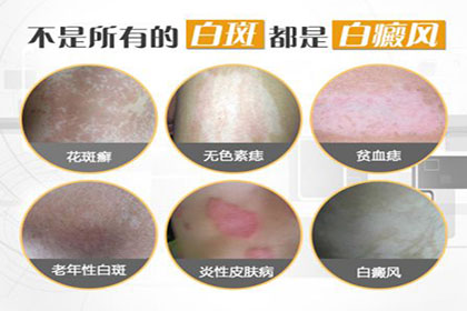 白癜风早期症状和哪些皮肤病症状相似?