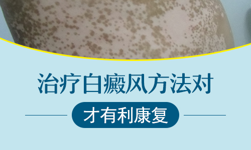 治疗白癜风选对方法很重要