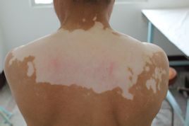 怎样治疗白癜风有效且花钱少?
