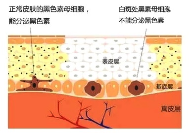 白癜风与黑色素之间存在怎样关系?